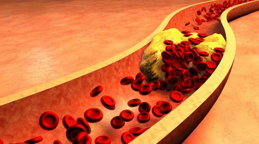 Kolesterol Pada Pembuluh Darah